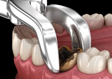 cerrahi diş tedavileri - diş çekimi - DENT777 Ağız ve Diş Sağlığı Polikliniği